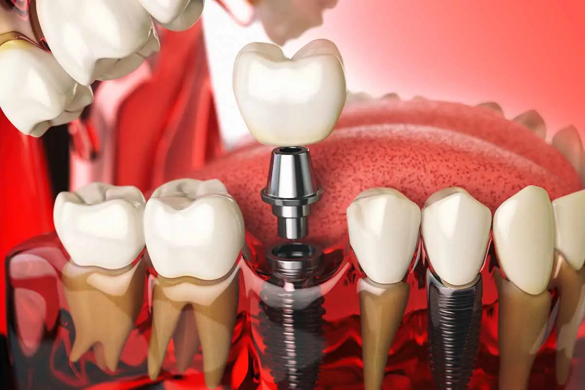 3D model showing how dental implants are placed